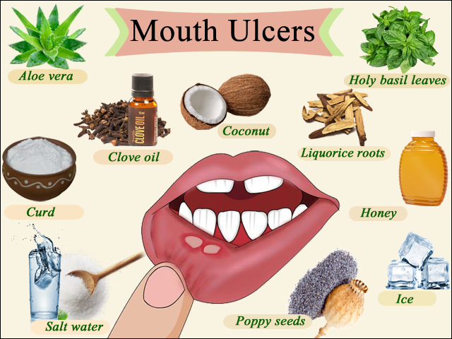 mouth-ulcers-signs-they-could-be-more-serious-and-when-to-see-a-gp