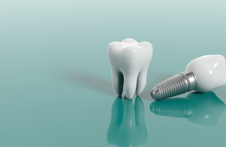 Dental Implants in Pune