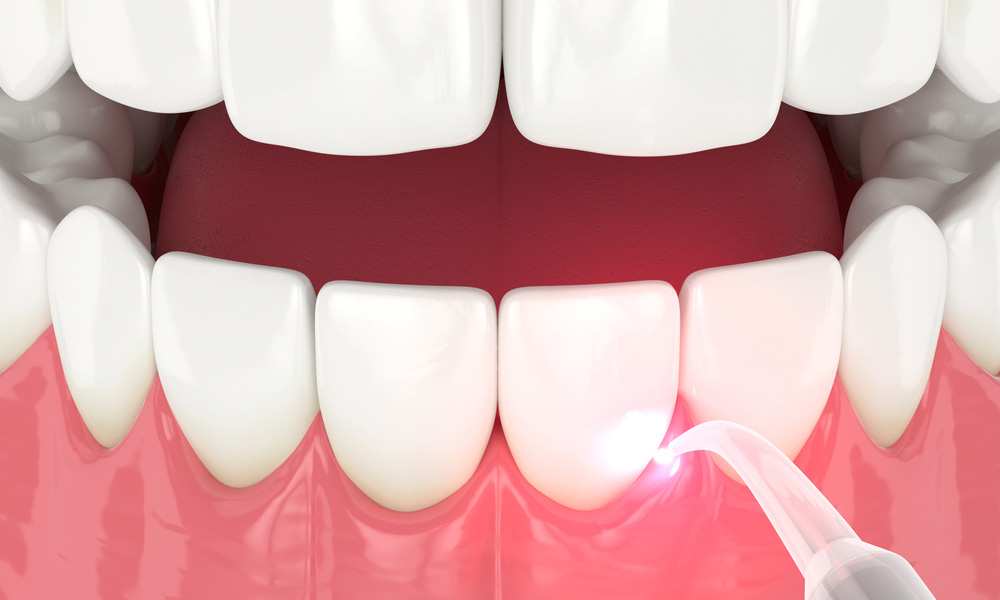 Dental Lasers Treatment in Pune