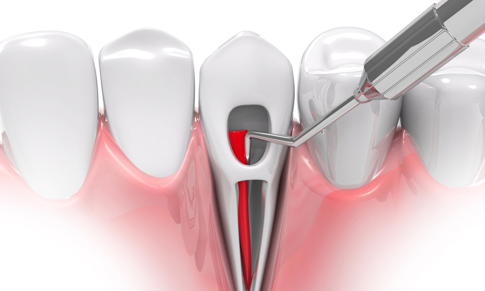 Painless Root Canal Treatment Pune