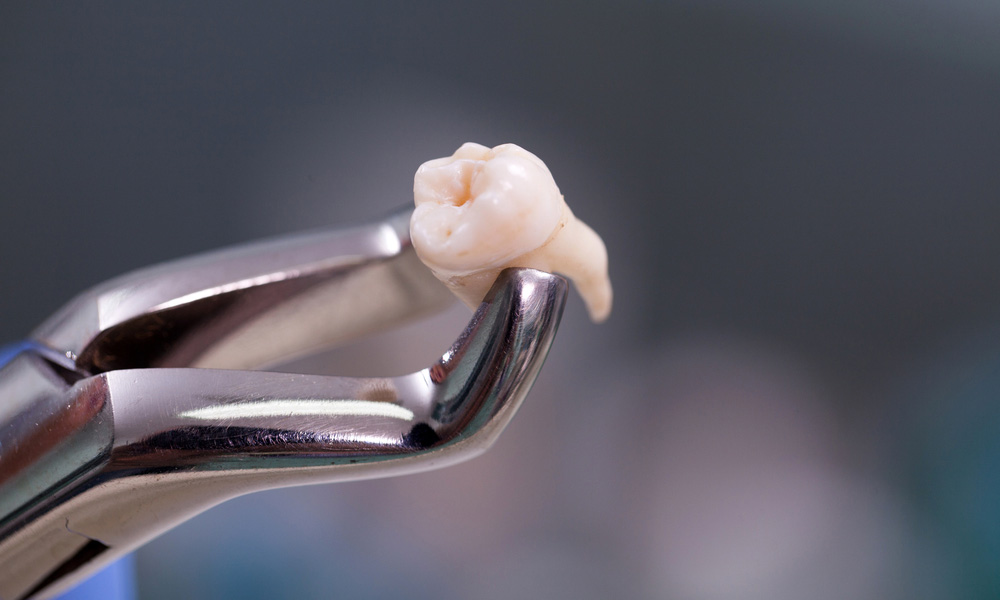 Painless wisdom tooth removal