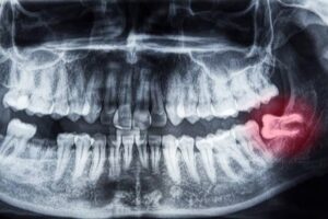Wisdom Tooth Removal